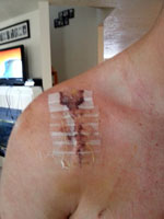 Post-op shoulder repair. Eeek!